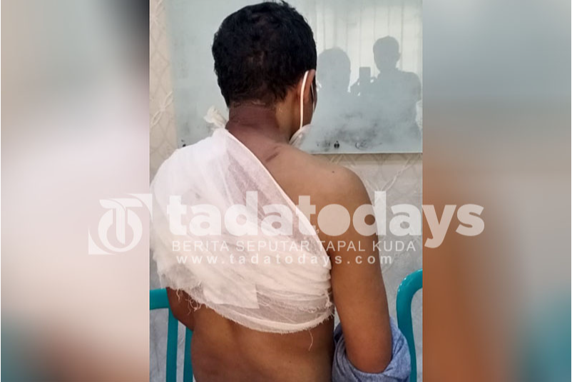 Pria di Banyuwangi Disiram Air Panas, Pelaku Ditangkap
